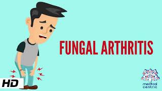 Fungal Arthritis, Causes, Signs and Symptoms, Diagnosis and Treatment.