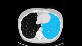 Automatic Synthesis of Anthropomorphic Pulmonary CT Phantoms