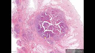 Mast cell tumour in the mammary gland of a dog // histopathology // Vanessa Herder