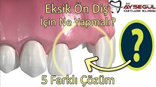 5 Different Treatments for Missing Front Tooth? What to Do After Tooth Extraction?