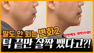 양악수술 없이 간단하게 무턱 해결하는 방법 II  - 턱끝수술(이부성형술)