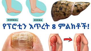 የፕሮቲን እጥረትን ጠቋሚ የመጀመሪያ 8 ምልክቶች| 8 signs of protein deficiency