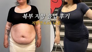 브이로그 | 복부 쳐진 살 썰고 왔어요 지방만 6.6L | 고도비만이 말하는 지방 흡입 •수술 2번 함, 복부지흡