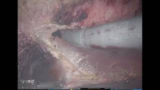 Robotic component, TAR, \u0026 retrorectus modified sugarbaker repair of parastomal hernia with synthetic