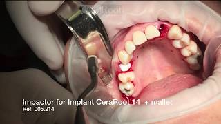 Surgery of two CeraRoot ceramic implants CR34 and CR14: Large Lateral Incisor and premolar