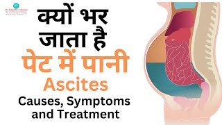 क्यों भर जाता है पेट में पानी,  #Ascites Causes, Symptoms and Treatment / #drzubindevshrma