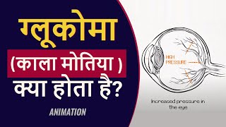 What is Glaucoma? | ग्लूकोमा क्या है? | Hindi