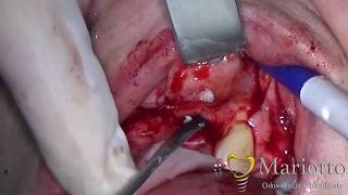 Autogenous bone graft from jjaw