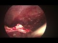 laparoscopic deroofing of large renal cyst compressing the pelvicalyceal system