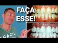 Qual Tipo de Clareamento Dental É MELHOR?