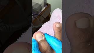 Ep_7466 *Foot nails skin removal 👣 การดูแลของหนู..ซับน้ำในซอกเล็บให้แห้ง 😄 (clip from Thailand)