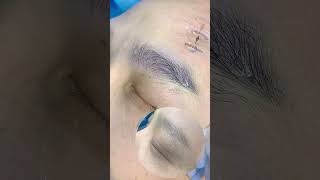 男士植眉eyebrow transplant