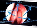 nasal endoscopy labelled slides