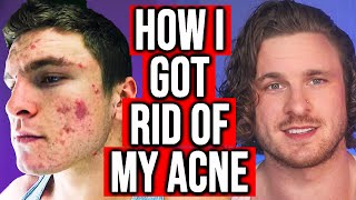 THREE WAYS TO GET RID OF ACNE FAST! (FROM EXPERIENCE)