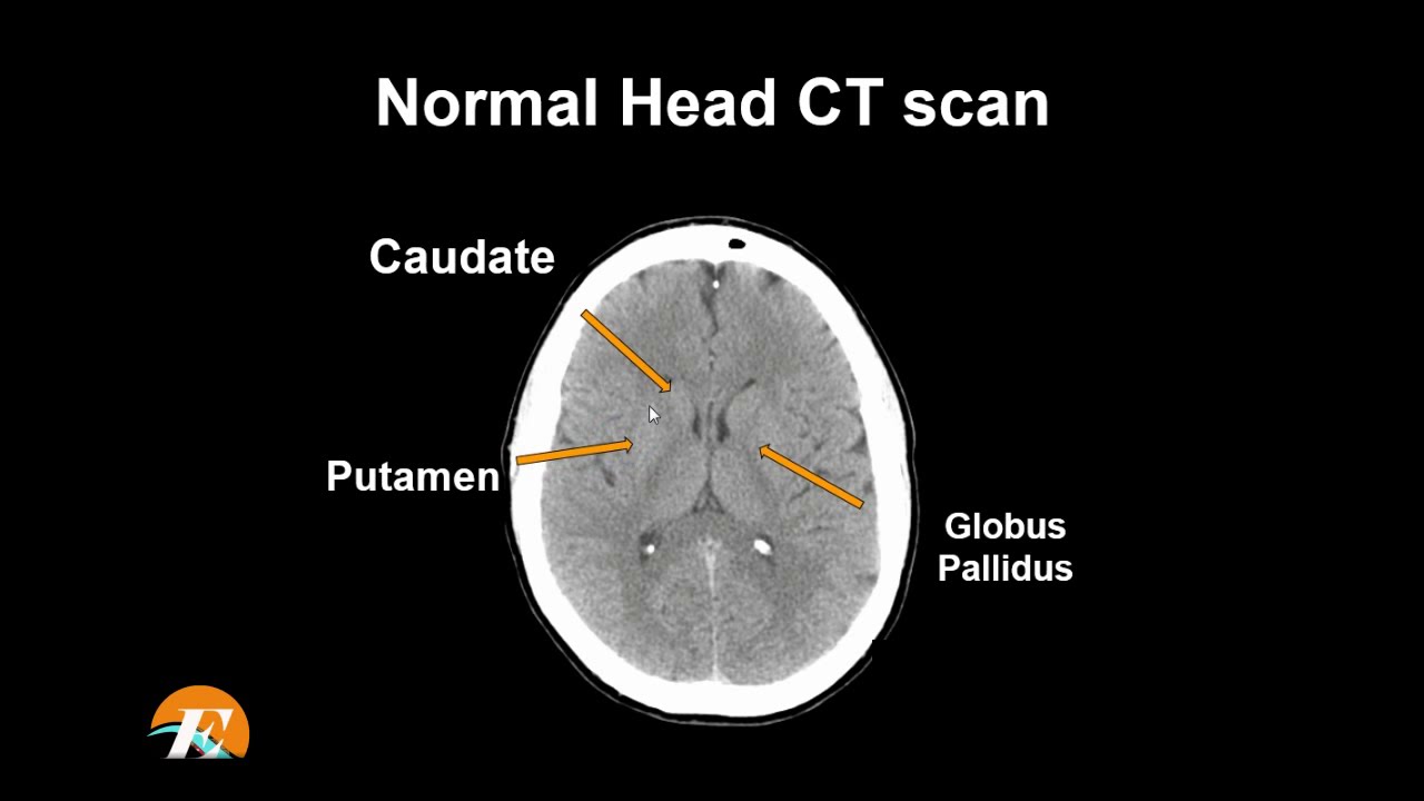 Normal Head Ct Scan Anatomy Made Simple Neuroradiology Youtube
