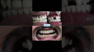 Smile Makeover for badly damaged teeth#shorts #viralvideo #trending #smilemakeover #fracture #teeth