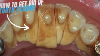 Massive Teeth Tartar Removal Get Rid of Hard Plaque on Teeth #09 🦷 DentalHome