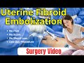 Uterine Fibroid Embolization | Surgery Video