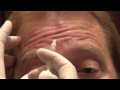 botox training forehead injections empire medical training