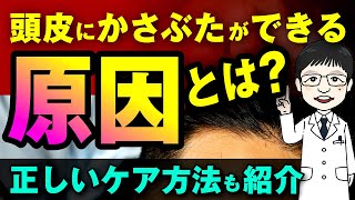 【医師が解説】頭皮のかさぶたができる原因とは？正しいケア方法も紹介