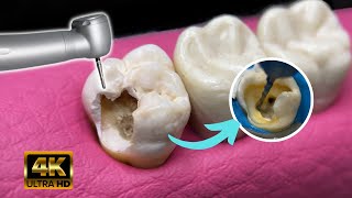 Repair teeth with cavities: Incredible transformation / Endodontics in 4K