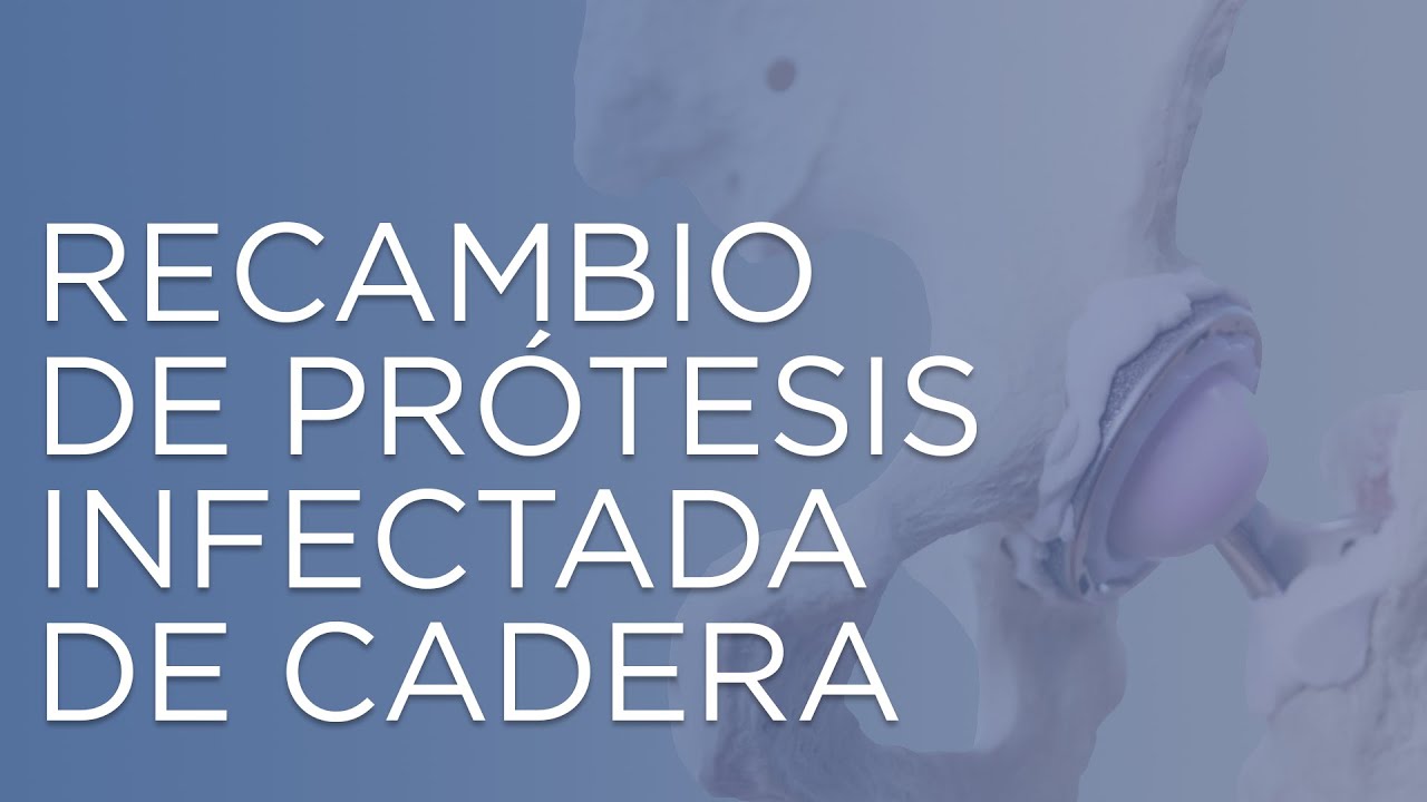 Cambio De Prótesis De Cadera Infectada | Prótesis De Cadera | Infección ...