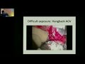 aioc2018 ic372 topic glaucoma implant surgery in complex situations dr.pandav surinder singh