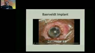 AIOC2018 - IC372 - Topic - Glaucoma Implant Surgery in complex situations - Dr.Pandav Surinder Singh