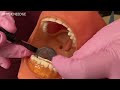 mirror trick to see anterior teeth better