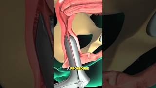 What Happens During a Hysteroscopic Polypectomy? #UterinePolyp #Hysteroscopy #Polypectomy