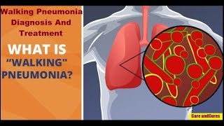 Walking Pneumonia Symptoms | Walking Pneumonia Diagnosis And Treatment| Walking Pneumonia Prevention