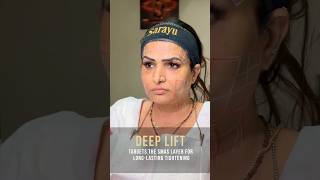 Non-Surgical Facelift with HIFU by Dr. Adarsh Tripathi | Sarayu Clinics #hifu