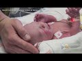 First Baby From A Uterus Transplant In The US Born In Dallas