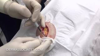 Basal Cell Carcinoma Surgery - Shoulder