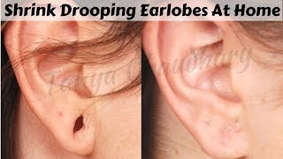 Top 3 Home Remedies To Shrink Drooping Earlobes Naturally At Home | 100% Effective Home Remedies
