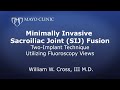 Minimally Invasive Sacroiliac Joint (SIJ) Fusion Two-implant technique utilizing Fluoroscopy views