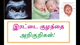 இரட்டை குழந்தை அறிகுறிகள் - TWIN PREGNANCY SYMPTOMS IN TAMIL