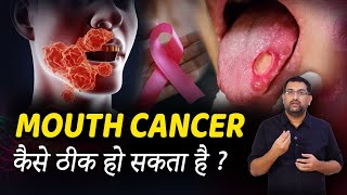 Mouth CANCER TREATMENT in hindi | मुँह का कैंसर | Cancer Treatment | Dr.Avinash Chaitanya | Kaizen