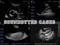 How To: Abdominal Ultrasound - Aorta Case Study Video