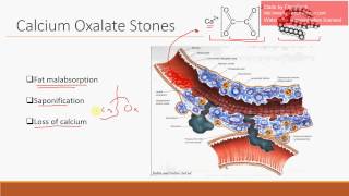 Calcium Oxalate Stones in Crohn Disease