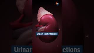 What is Multicystic Dysplastic Kidney (MCDK) | Symbiosis Speciality Hospital