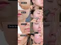 quick gua sha moves for doublechin smilelines tmj sculptedface