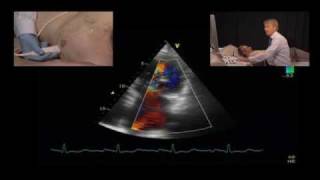 Jet Direction and the Mechanism of Mitral Regurgitation