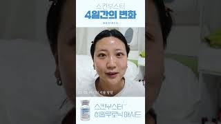 [홈케어] MTS 롤러 4일 간의 기록!!💪 | 스킨부스터 | 결과 있음 | 비포/에프터 | 피부 관리 #shorts