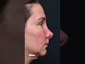 Tiffany's Rhinoplasty Journey