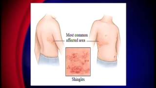 Shingles and How to Protect Yourself from it