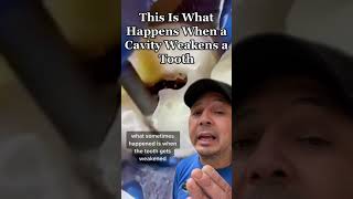 Watch What Happens When a HUGE Cavity WEAKENS a Tooth | View Mobile Dental