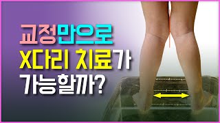 다리 교정으로 X다리 치료가 될까요?