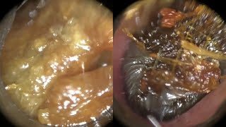 145 - Masses of Ear Wax Removed from Interior \u0026 Anterior Recess of Bendy Ear using WAXscope®️