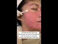 microneedling plus tca 15% peel for acne scars shorts